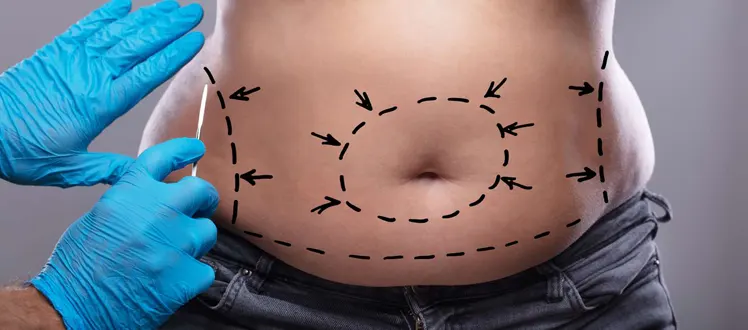 Faut-il perdre du poids avant une abdominoplastie ?