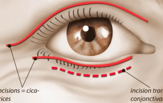 blepharoplastie-paupieres-superieures-inferieures