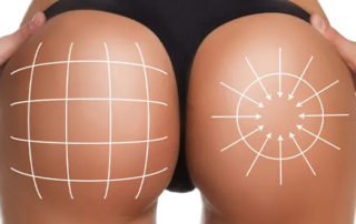 précautions à prendre après un lipofilling fessier