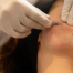 il est temps de réaliser vos injections de Botox