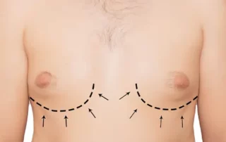 traitement gynécomastie Tunisie