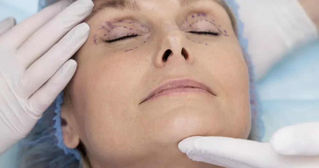 chirurgie esthétique des paupières