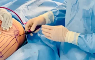 traitement Renuvion J-Plasma