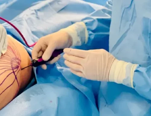 Dans quels cas recommande-t-on le traitement Renuvion J-Plasma ?